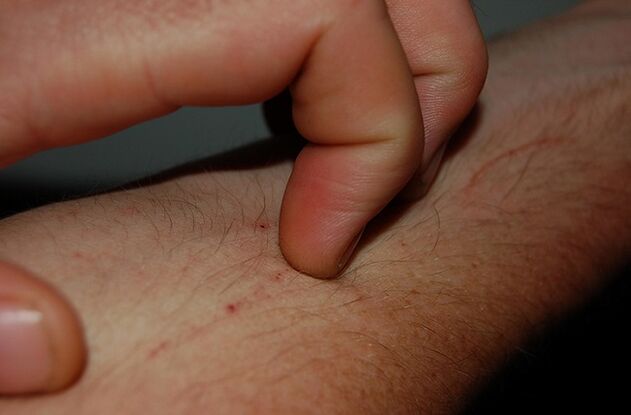 skin itching as a symptom of the presence of parasites