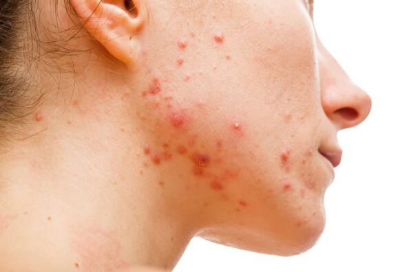 acne due to subcutaneous parasites