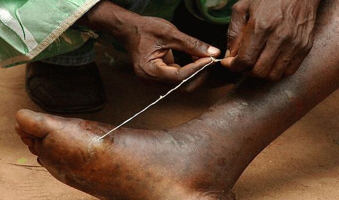 extraction of the subcutaneous parasite from the foot