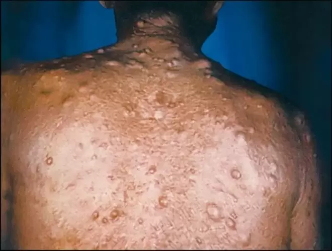 purulent knots on the skin due to parasites