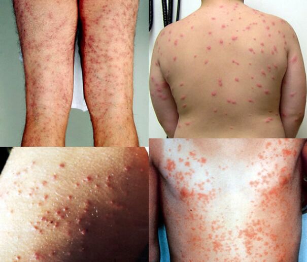 rashes all over the body due to parasites