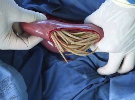 parasites in the intestine